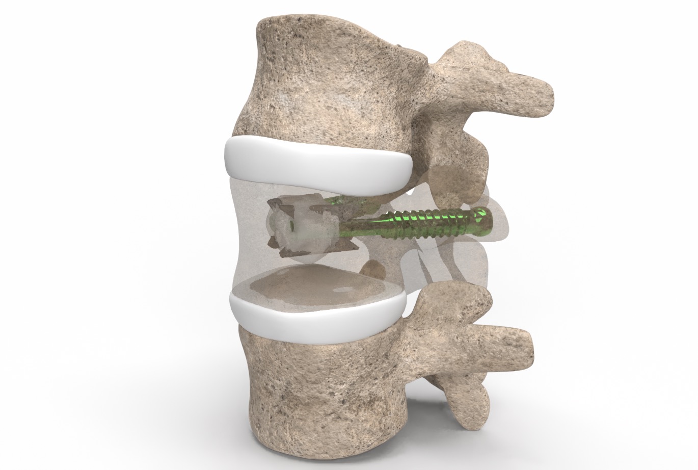 Amber Implants expands EXPAND study of VCFix to eight European centres
