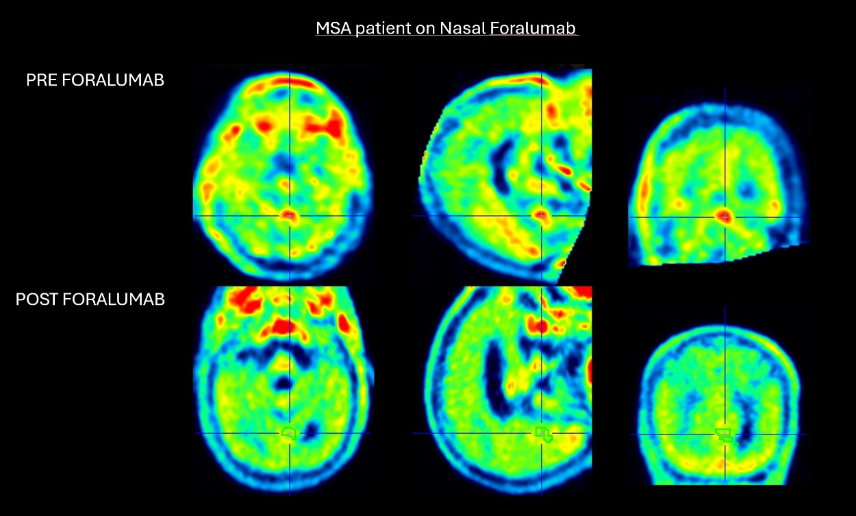 Tiziana sees neuroinflammation fall in third MSA patient on foralumab