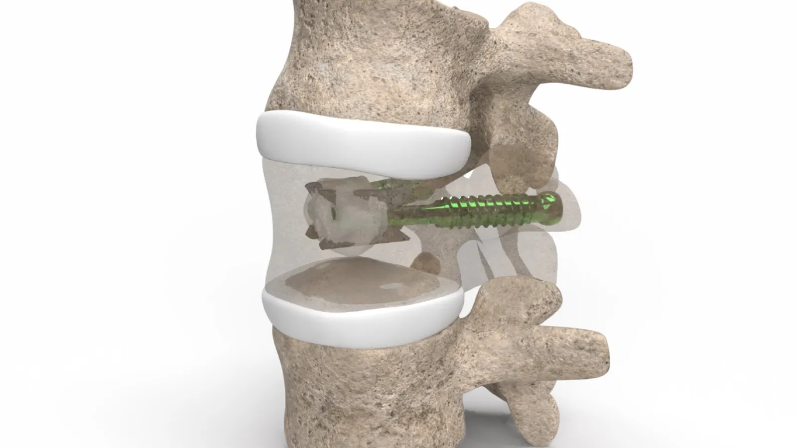 Amber Implants expands EXPAND study of VCFix to eight European centres