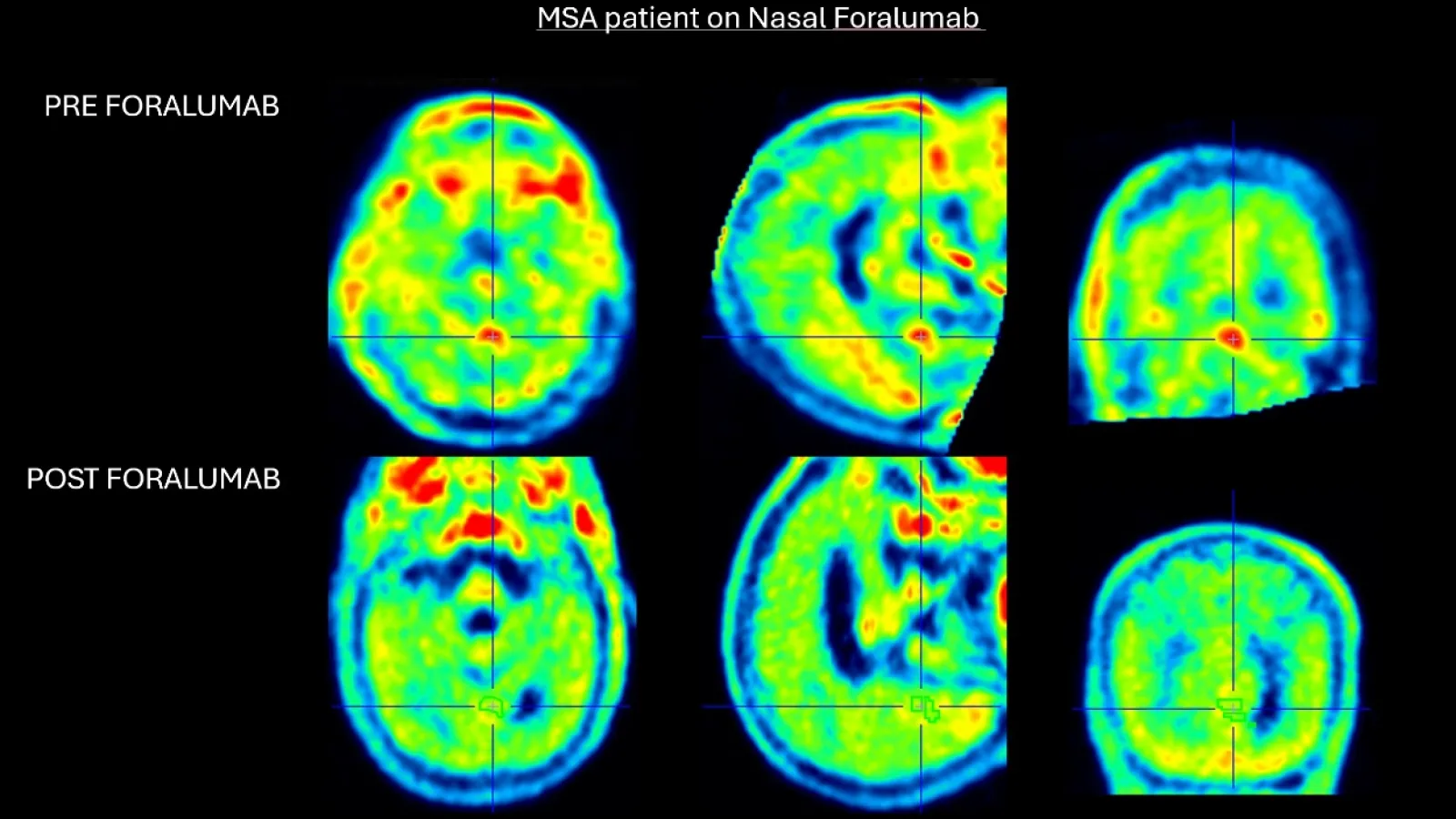 Tiziana sees neuroinflammation fall in third MSA patient on foralumab